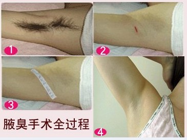 微创技术治疗效果图.jpg